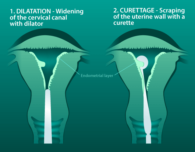 heavy bleeding perimenopause