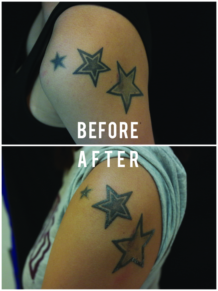 To rub out the stars: Quick, cheap, but not pain-free tattoo removal
