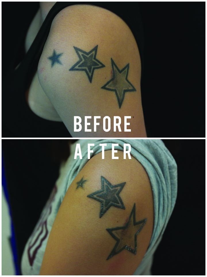 To rub out the stars: Quick, cheap, but not pain-free tattoo removal ...