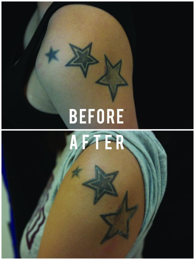 To Rub Out The Stars Quick Cheap But Not Pain Free Tattoo Removal To Rub Out The Stars Quick Cheap But Not Pain Free Tattoo Removal