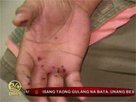 Hospitals treat more firecracker blast  victims