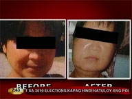 Nurse sues Belo Medical Group over failed skin procedure