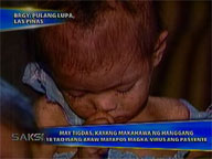 <b>Saksi: </b>Measles patient may infect up to 18 others in one day after he gets virus