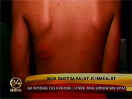 Public warned vs summer skin diseases