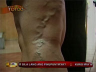 <b>Kapusong Totoo: </b>Facts about varicose veins