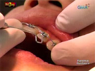 <b> Mel and Joey: </b> Braces