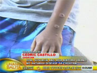 DOH to check on suspected victims of Anthrax disease in Cagayan