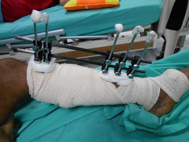 Sundalo na Marawi war casualty nagpapagaling sa V. Luna | GMA News Online