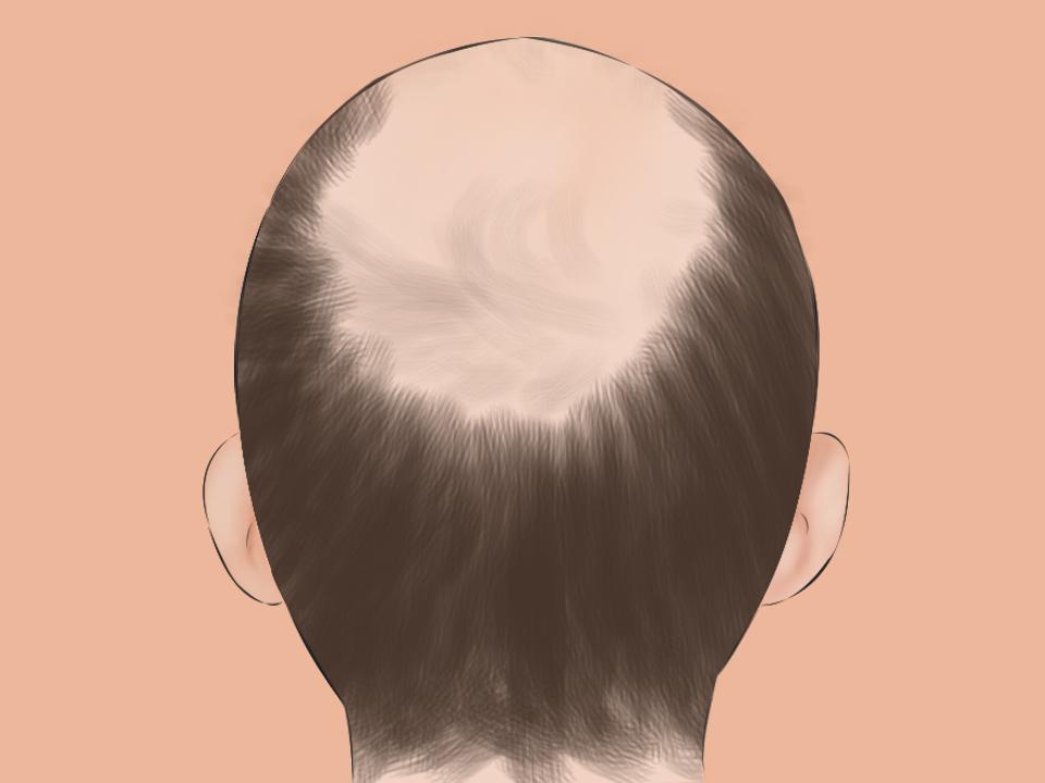 Alopecia: What are its causes and symptoms? Can it be treated and cured? |  GMA News Online
