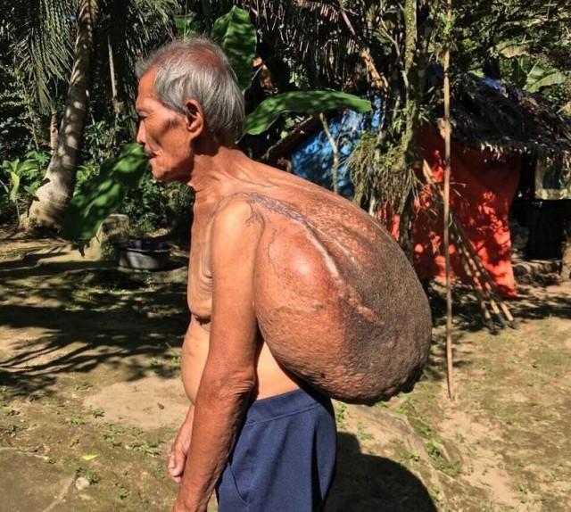 Lolo Jesus's 10kg-cyst