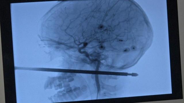 This image courtesy of Medical News Network shows an X-ray of Xavier Cunningham, 10, after a meat skewer impaled his skull on September 8, 2018. HO/Medical News Network/AFP