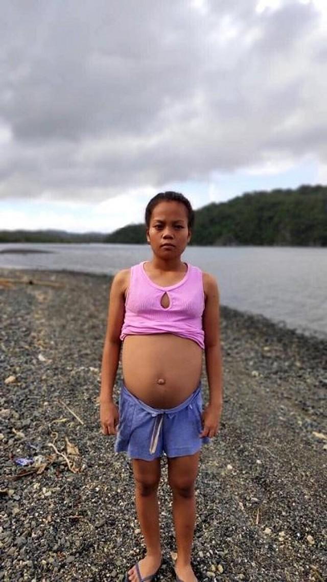 Albay town believes 17-year-old girl is pregnant with fish