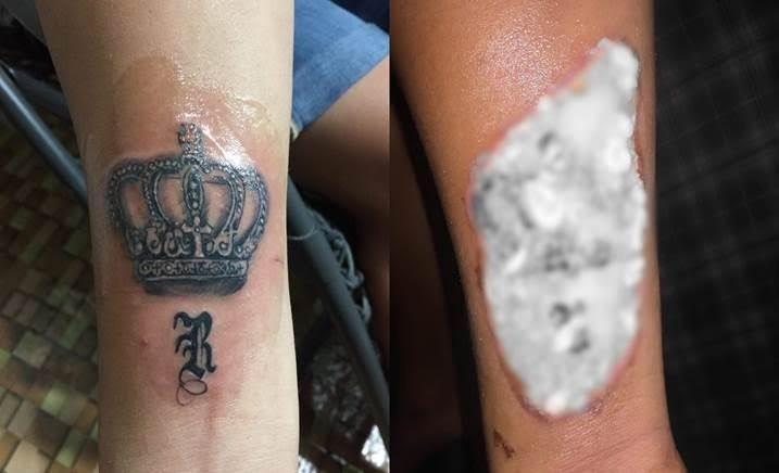 Man gets burns after resorting to DIY tattoo removal | GMA News Online