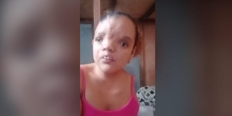 Woman With Facial Deformity Wows With Angelic Singing Voice Gma News Online