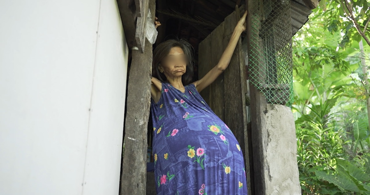 Why does this 57&year&old Cebu woman have an abnormally enlarged stomach?
