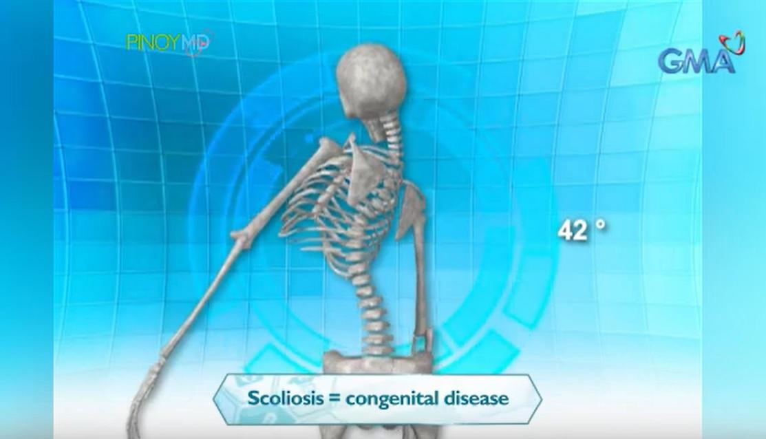 DOH Early Detection Needed For Scoliosis Treatment GMA News Online