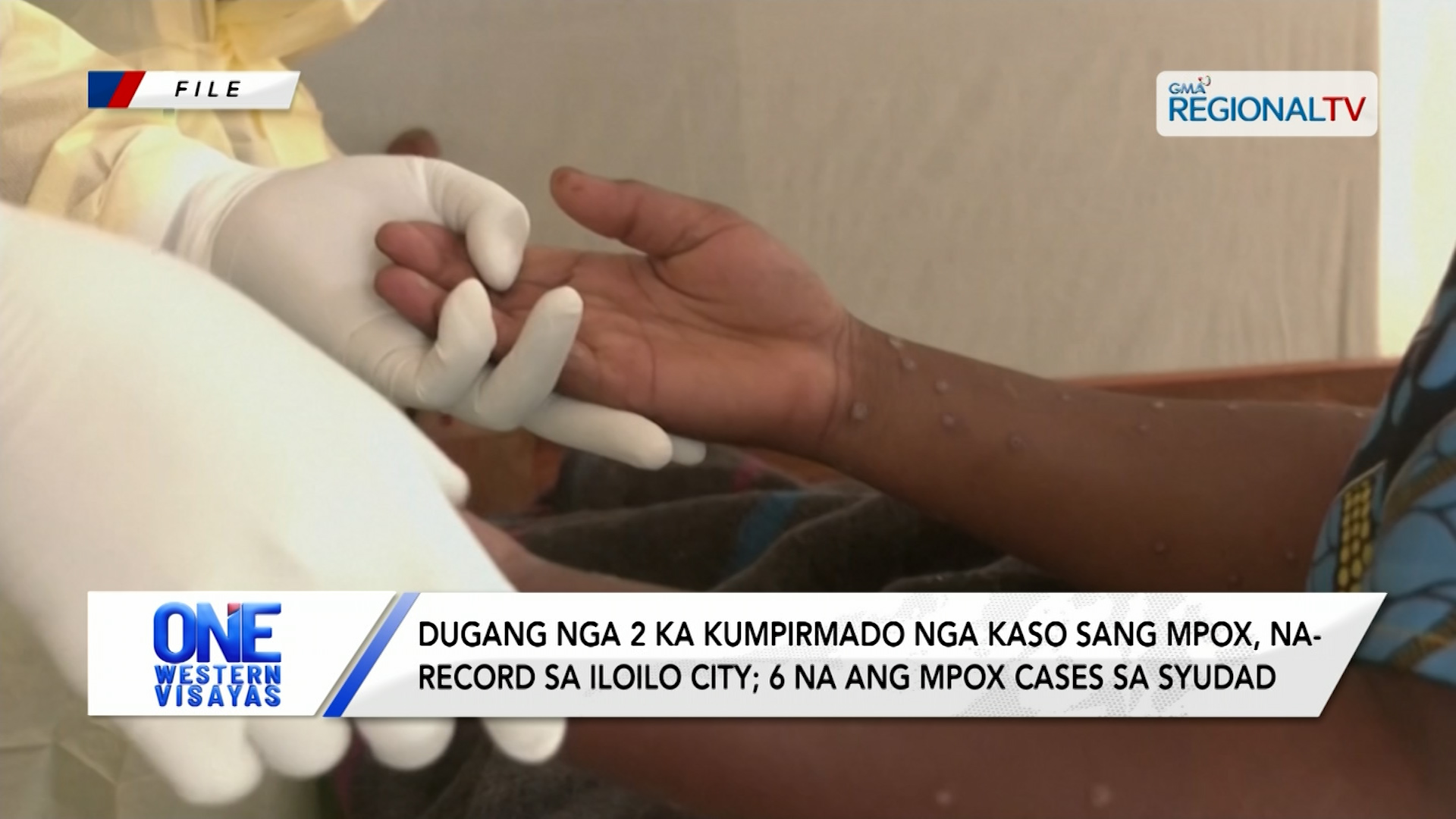 Dugang nga 2 ka kumpirmado nga kaso sang MPOX, na-record sa Iloilo City