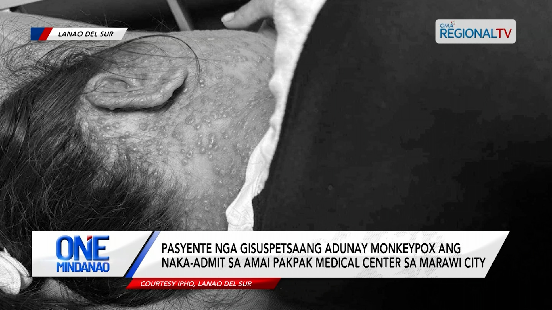 Pasyente nga dunay Monkeypox , naka-admit sa Marawi City