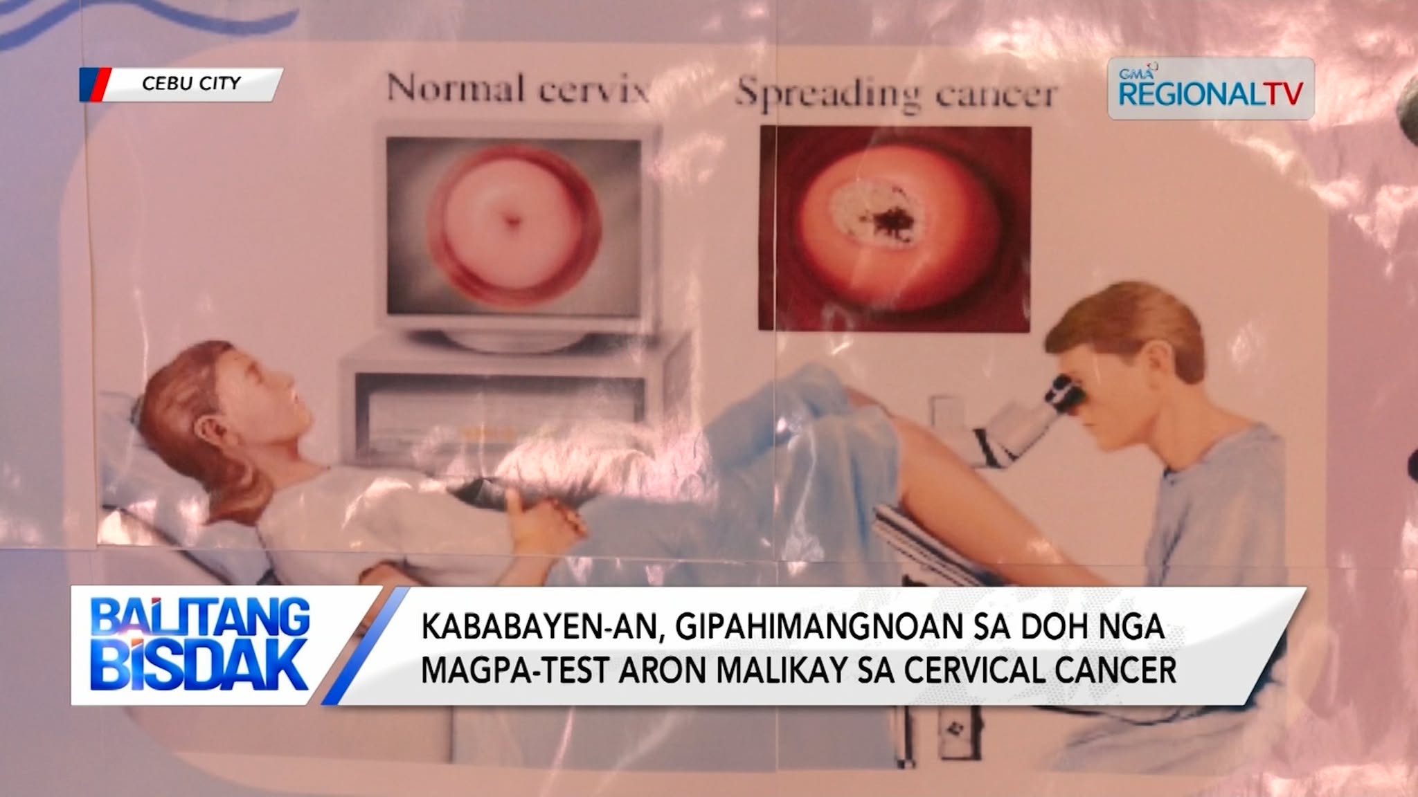 Kababayen-an, gidasig sa DOH nga magpa-test aron malikay sa cervical cancer