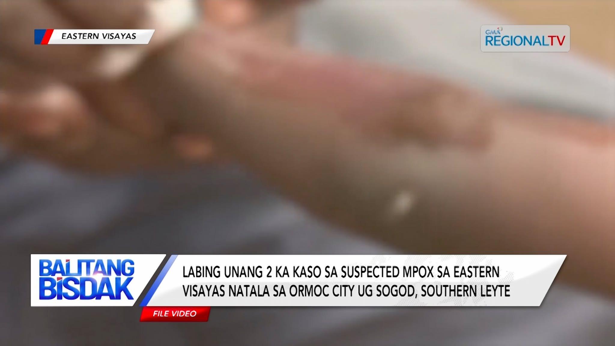 Labing unang 2 ka kaso sa suspected Mpox, natala sa Eastern Visayas