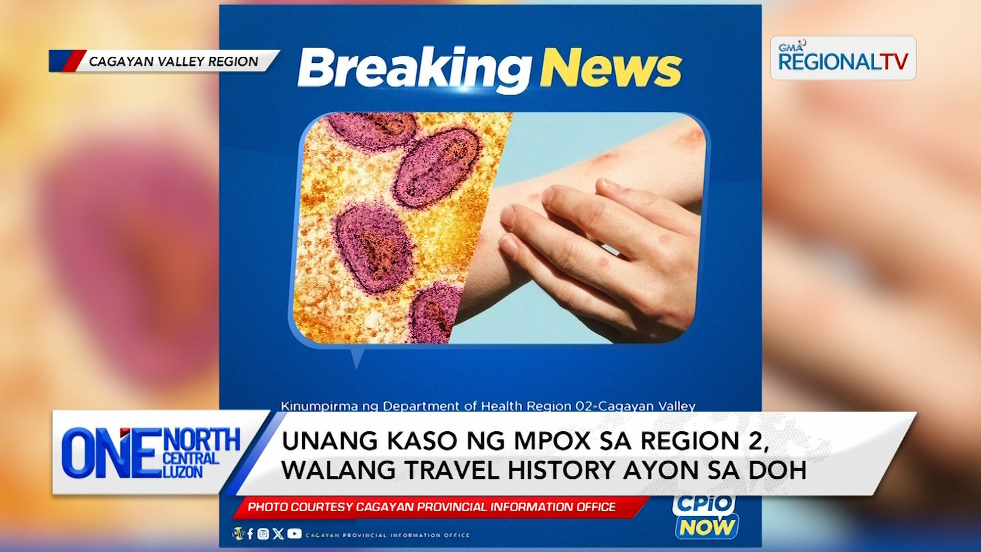 Unang kaso ng MPOX sa Region 2, walang travel history ayon sa DOH