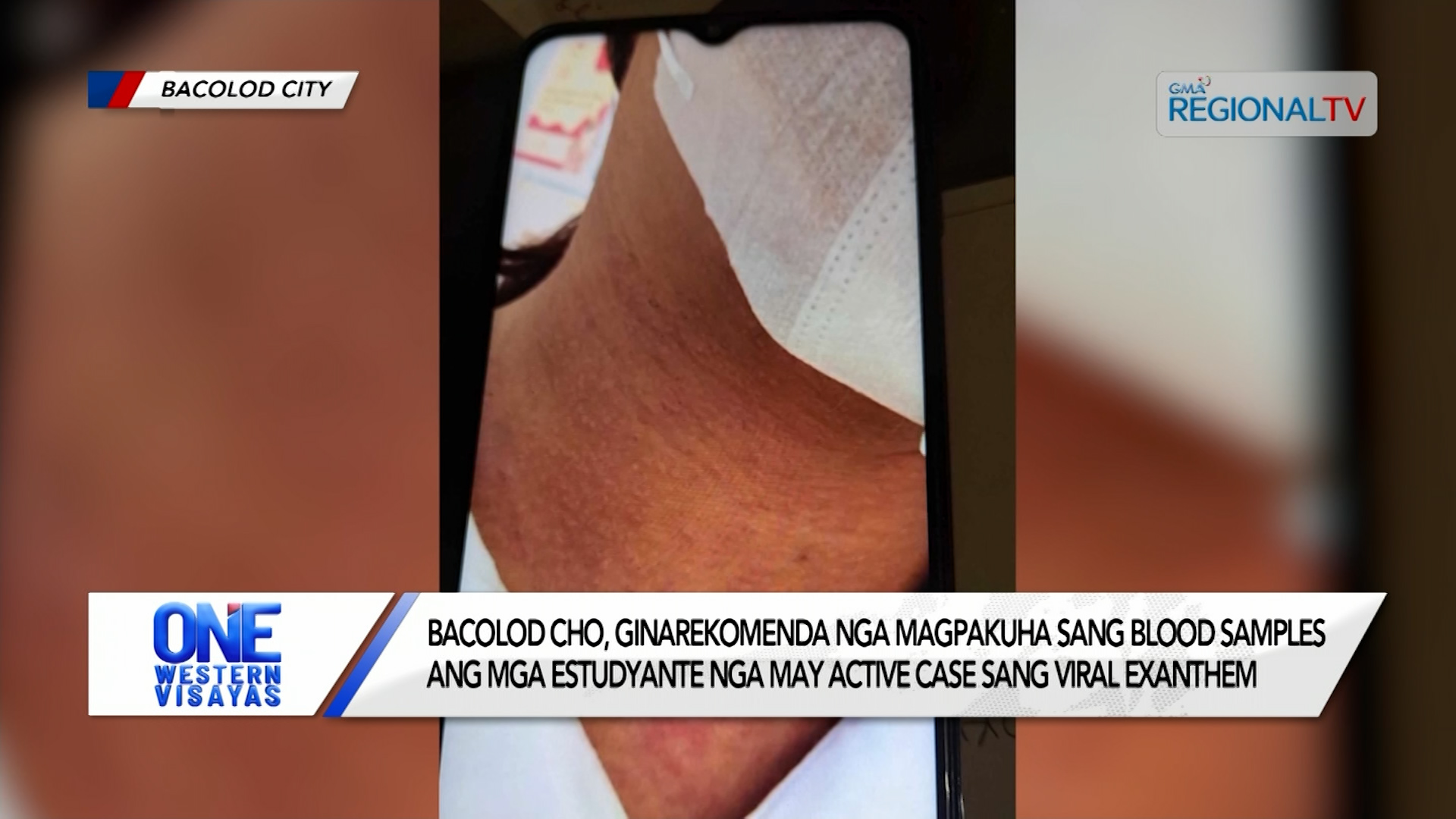 Pagpakuha sang blood samples sa active case sang viral exanthem, ginarekomendar