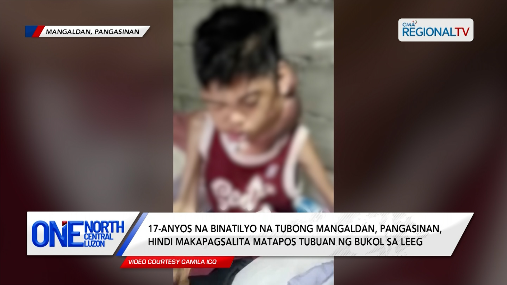 17-anyos na binatilyo na tubong Mangaldan, tinubuan ng bukol sa leeg | One North Central Luzon