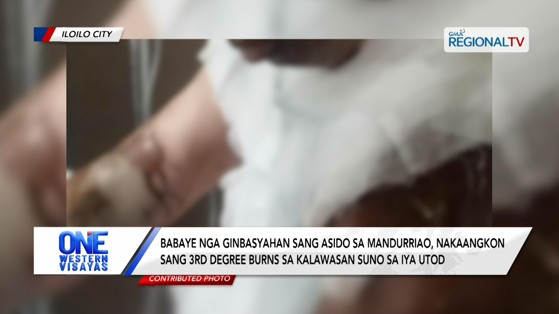 Babaye nga ginbasyahan sang asido sa Mandurriao nakaangkon sang 3rd degree burns
