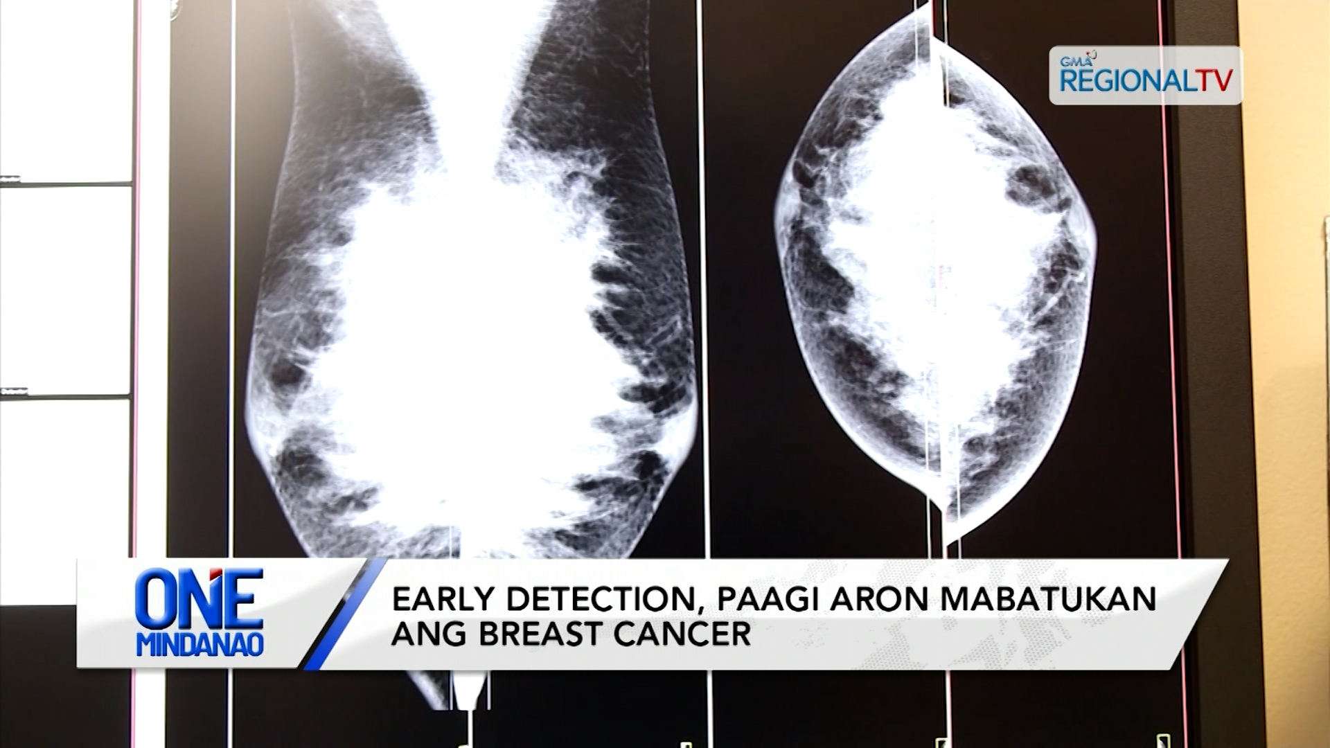 Early detection, paagi aron mabatukan ang breast cancer | One Mindanao