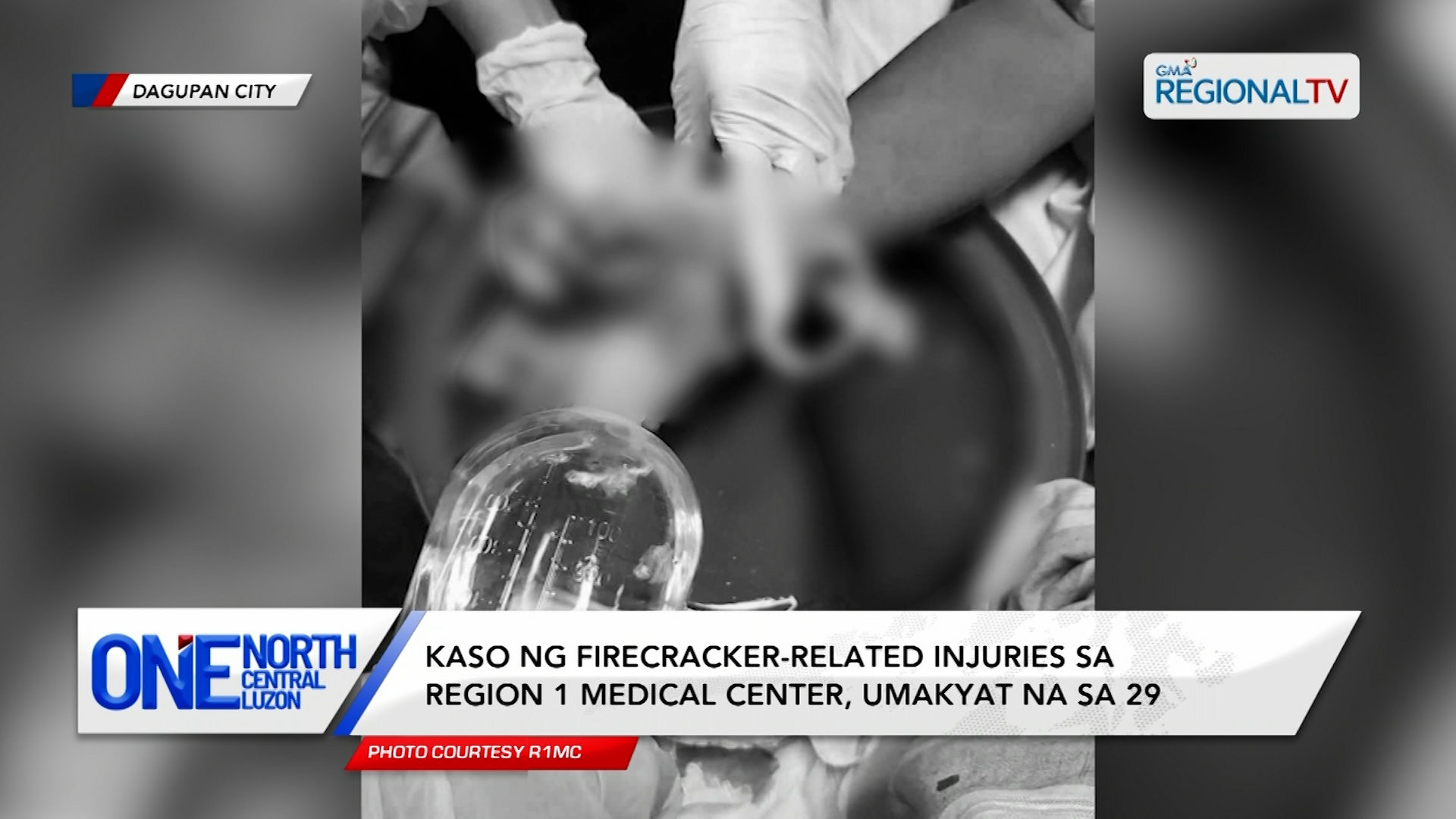 Kaso ng firecracker-related injuries sa R1MC, umakyat na sa 29 | One North Central Luzon