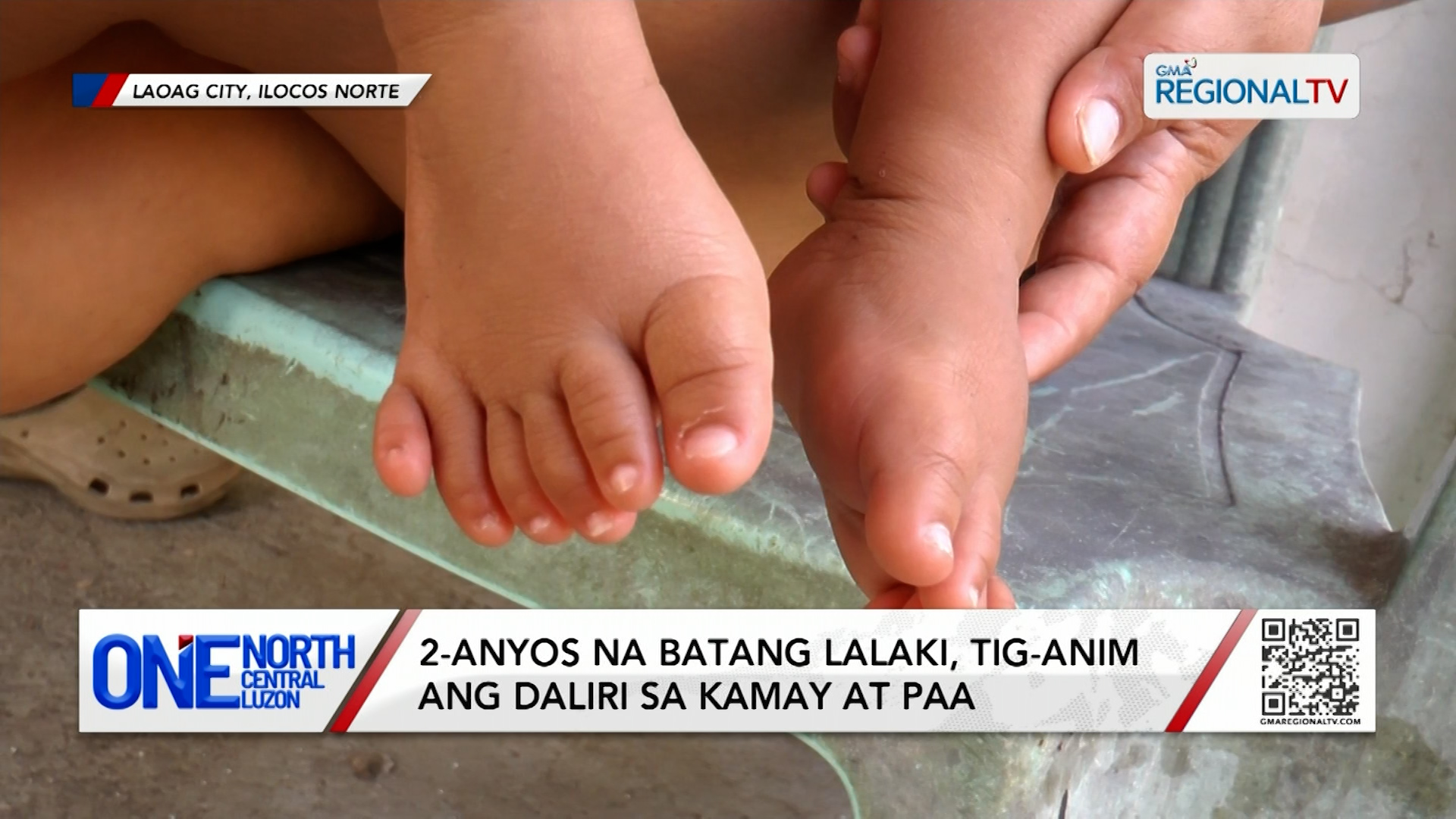 2-anyos na batang lalaki, tig-anim ang daliri sa kamay at paa | One North Central Luzon