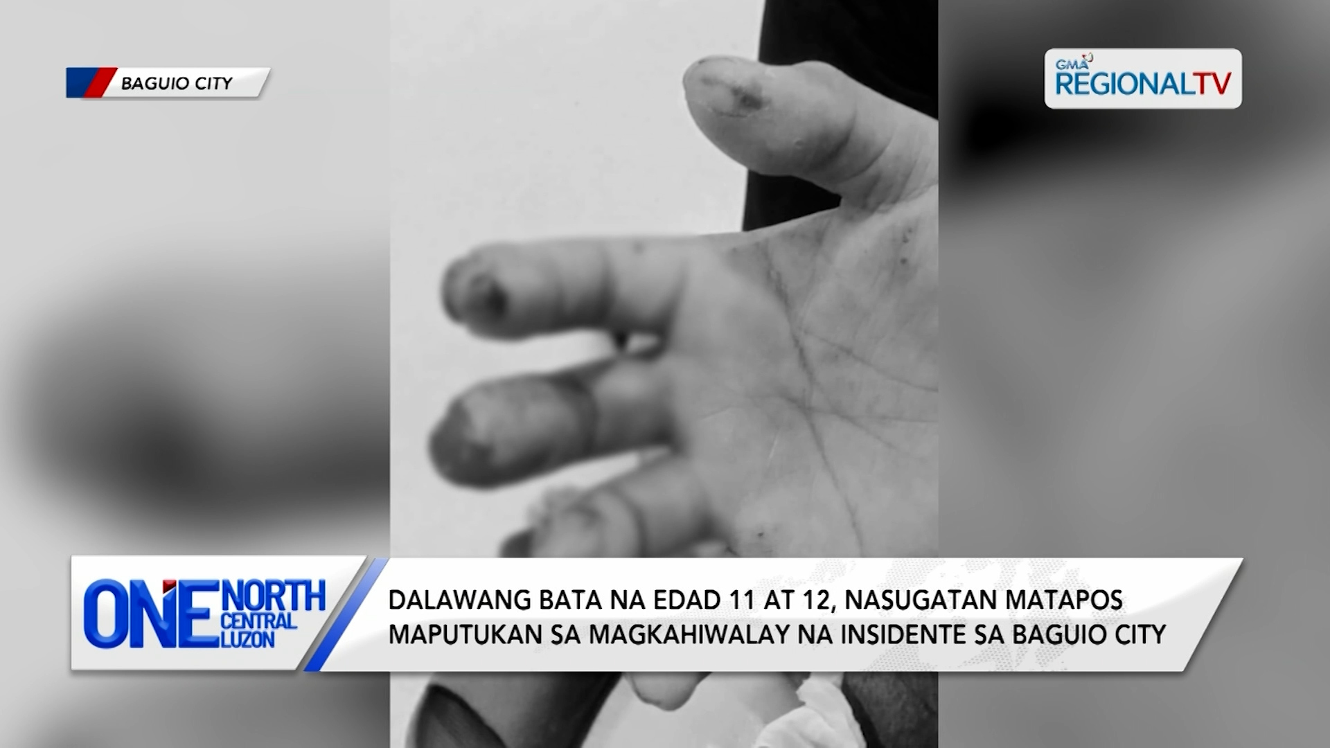 Dalawang bata na edad 11 at 12, nasugatan matapos maputukan sa Baguio City | One North Central Luzon