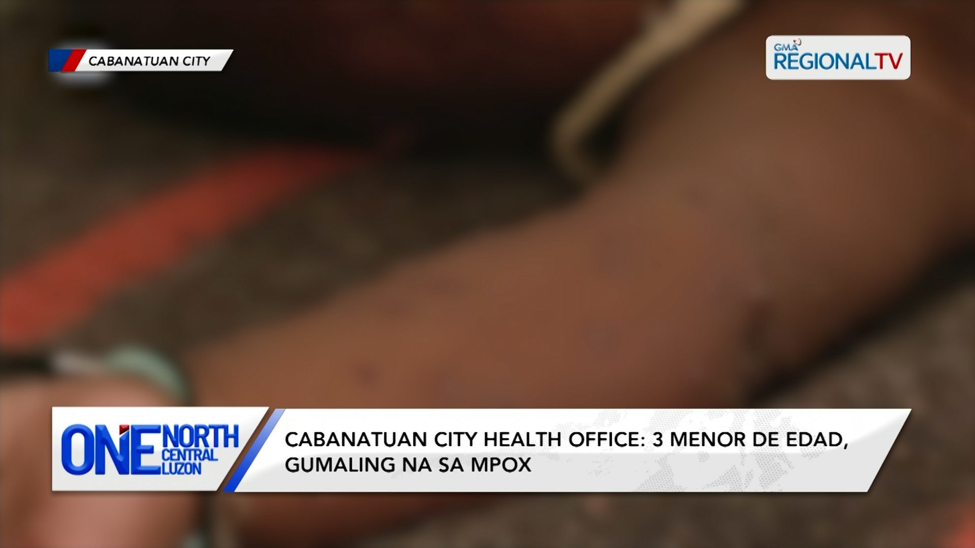 Cabanatuan City Health Office: 3 menor de edad, gumaling na sa MPOX