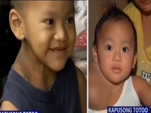 Operasyon sa batang may malaking bukol sa leeg, natuloy na