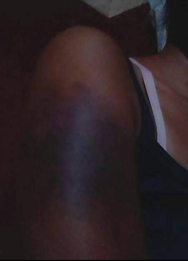 Calma shows her severely bruised upper right arm. --R. Concha