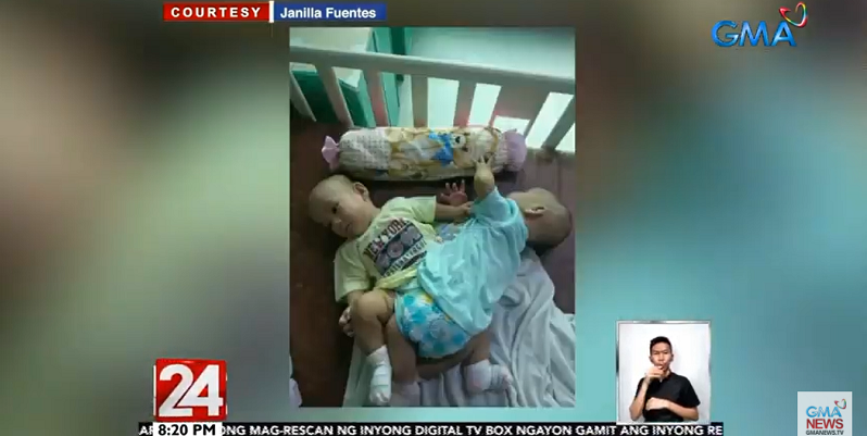 Conjoined twins separated amid pandemic | GMA News Online