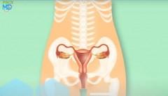 Cervical cancer