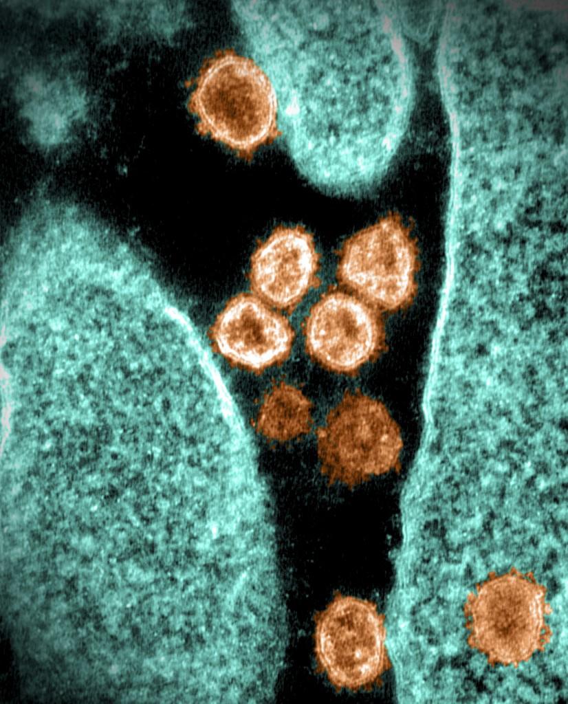 Antibodi flu biasa dapat menghambat pertahanan terhadap SARS-CoV-2 Berita GMA Online