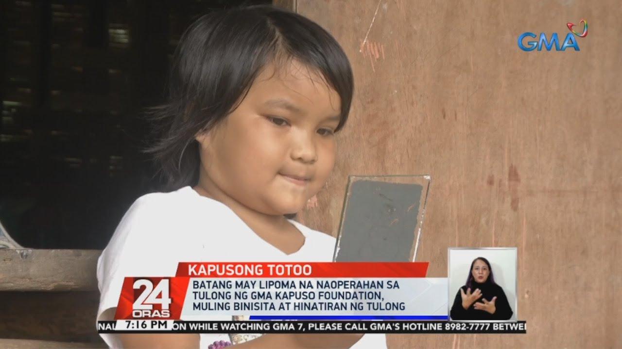 child-with-huge-lump-on-cheek-undergoes-surgery-with-help-of-gma-kapuso