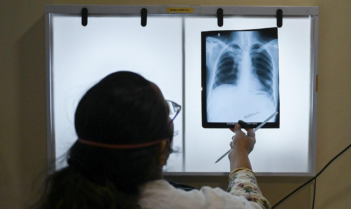 At least 447,696 actual tuberculosis cases reported in 2022 – DOH