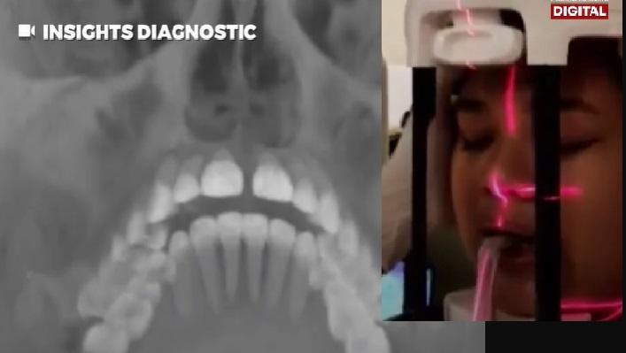 Teknologi sinar-X baru, mendeteksi gigi tersembunyi di mulut pasien