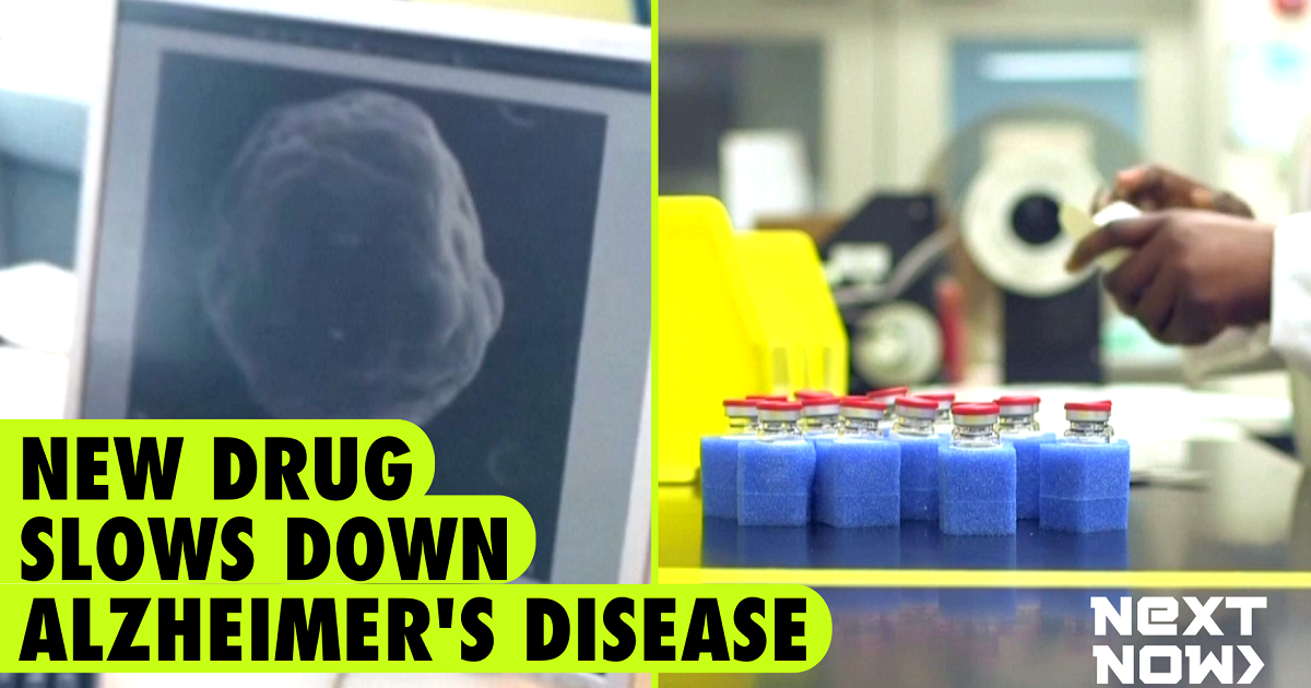 New Drug Slows Down Decline Of Patients With Alzheimers Disease Gma News Online