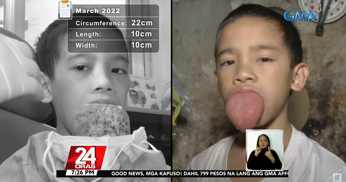 Child with tumor in tongue now slowly recovering thanks to GMA Kapuso Foundation