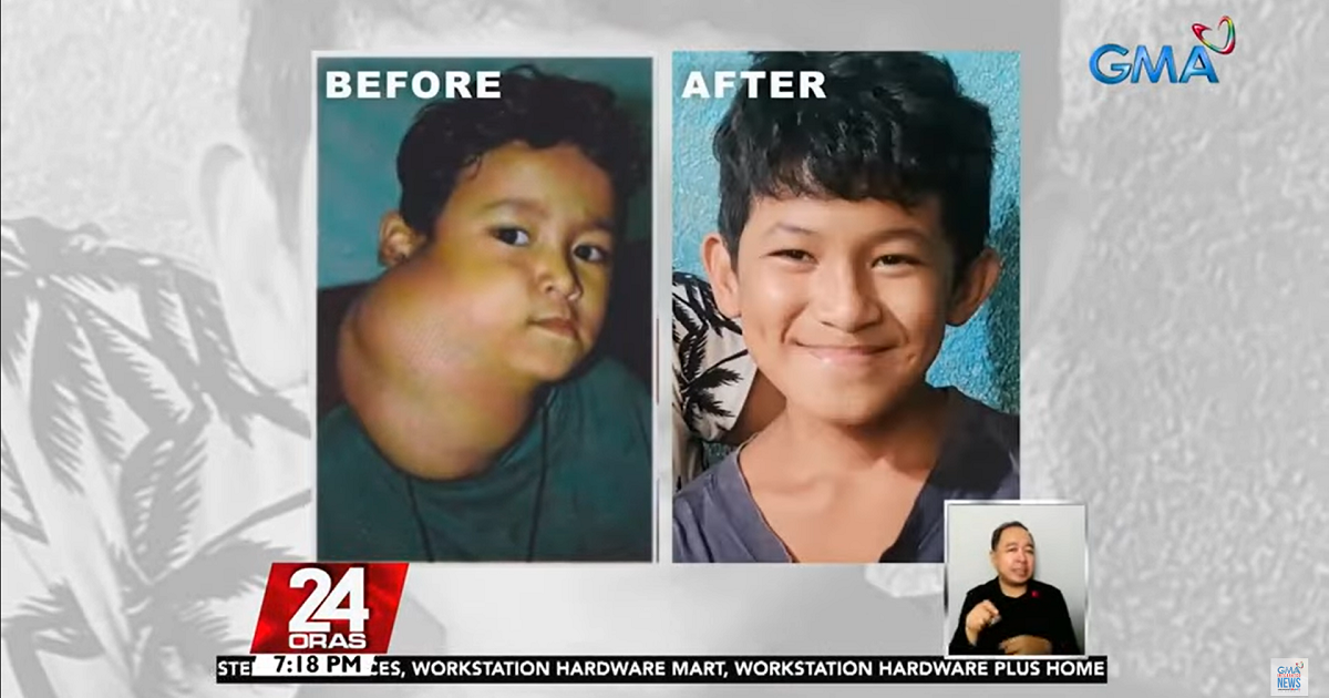 Young boy who had large lump on his neck recovers with help of GMA Kapuso Foundation