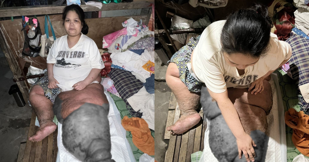 Woman in Laguna whose leg swelled up gets rescued from own home after over a decade