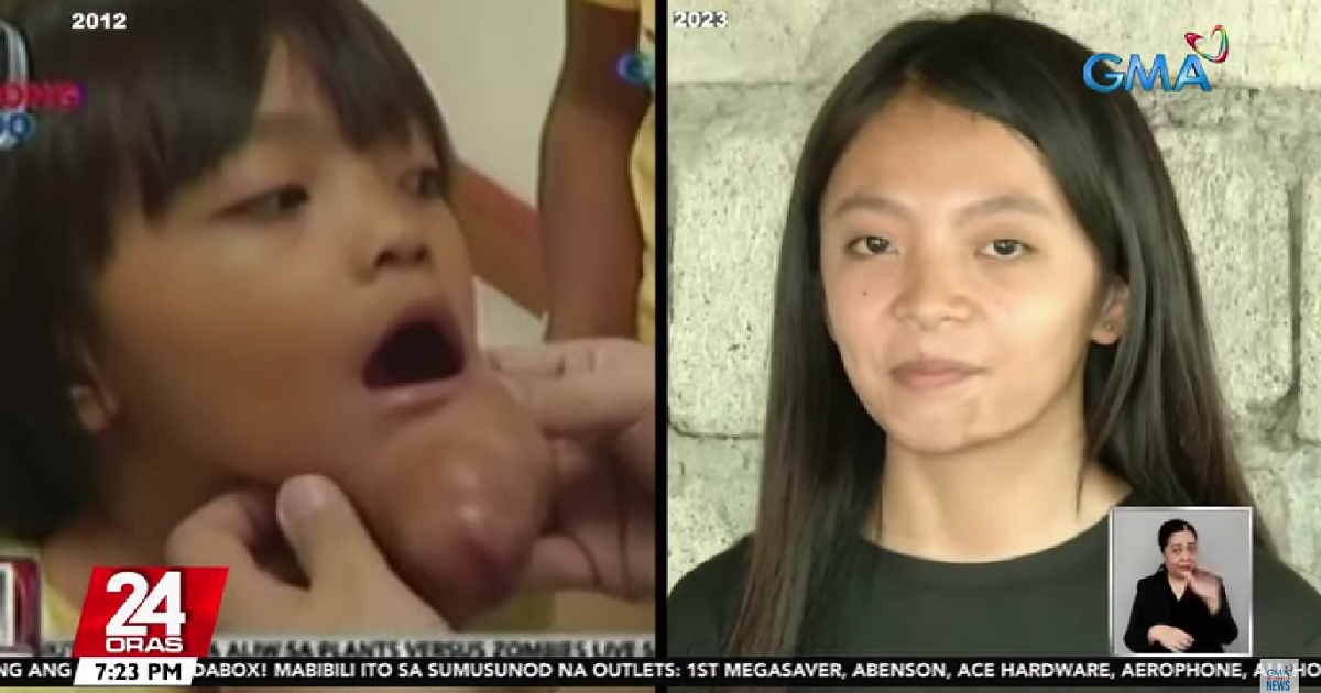 Girl with lump on her chin 10 years ago now doing well thanks to GMA Kapuso Foundation