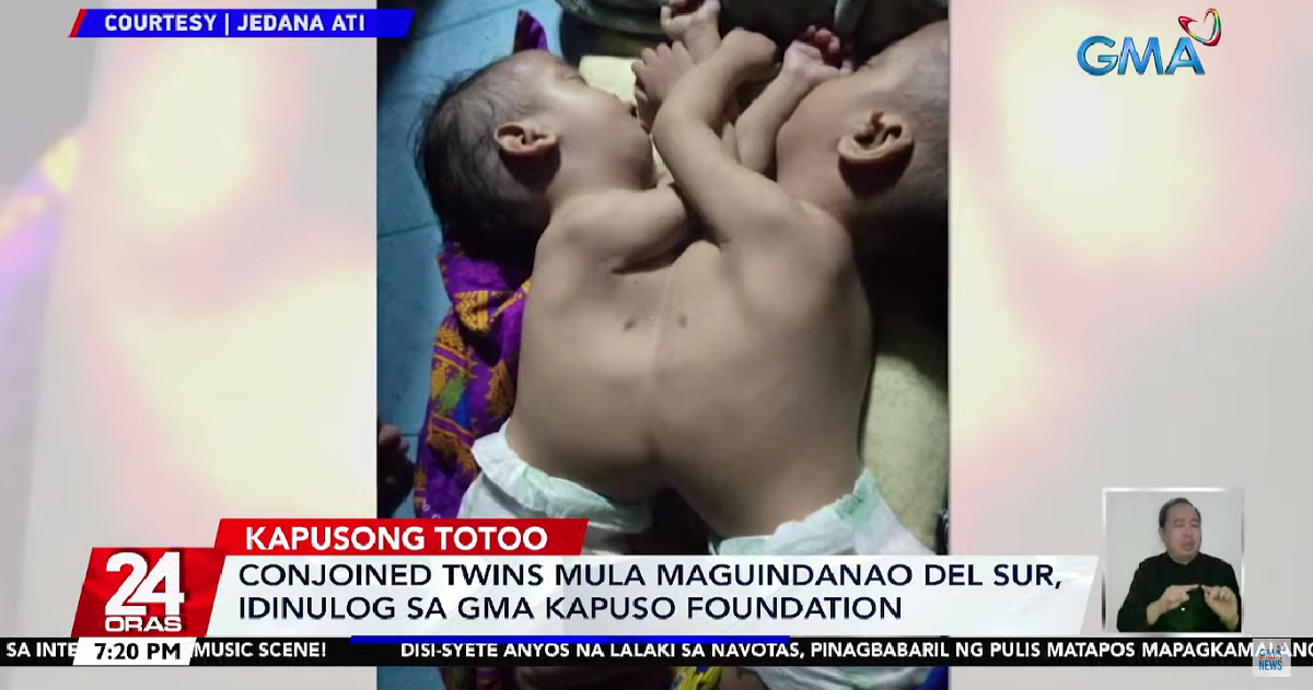 Parents seek help for conjoined twins from Maguindanao del Sur thumbnail