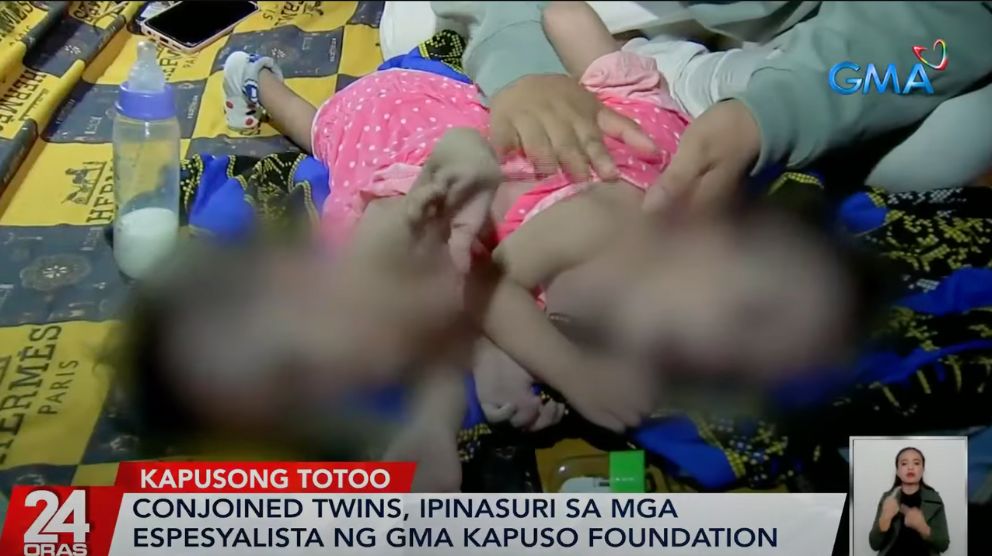 Conjoined twins receive professional consultations courtesy of GMA Kapuso Foundation