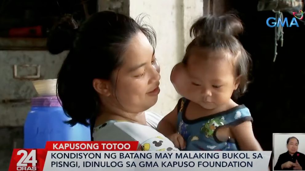 10-month-old baby from Cagayan receives help from GMA Kapuso Foundation