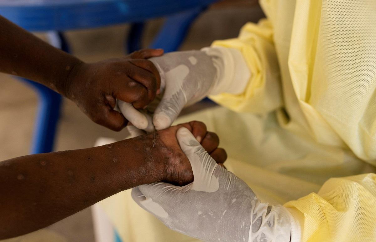 WHO declares mpox a global public health emergency for second time in two years